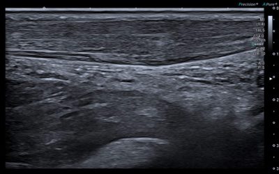 Echographie Doppler