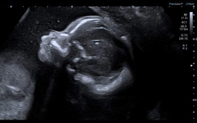 Echographie obstétricale
